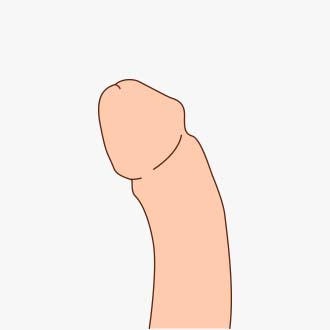 체외충격파 시술과정01