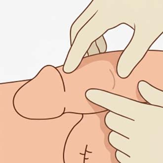 조루 고주파 치료 과정01