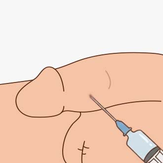 조루 고주파 치료 과정02