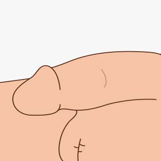 조루 고주파 치료 과정04