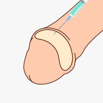 체외충격파 시술과정02