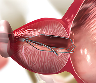 아이틴드 시술과정01