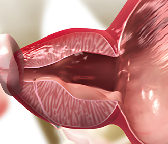 아이틴드 시술과정03