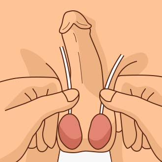 무도정관수술방법01