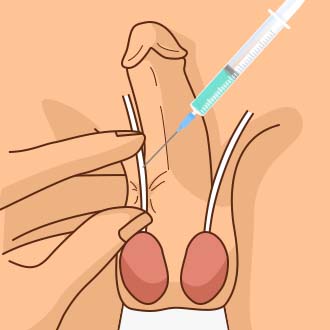 무도정관수술방법02