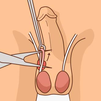 무도정관수술방법03