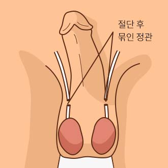 무도정관수술방법04